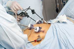 Minimally invasive abdominal surgery