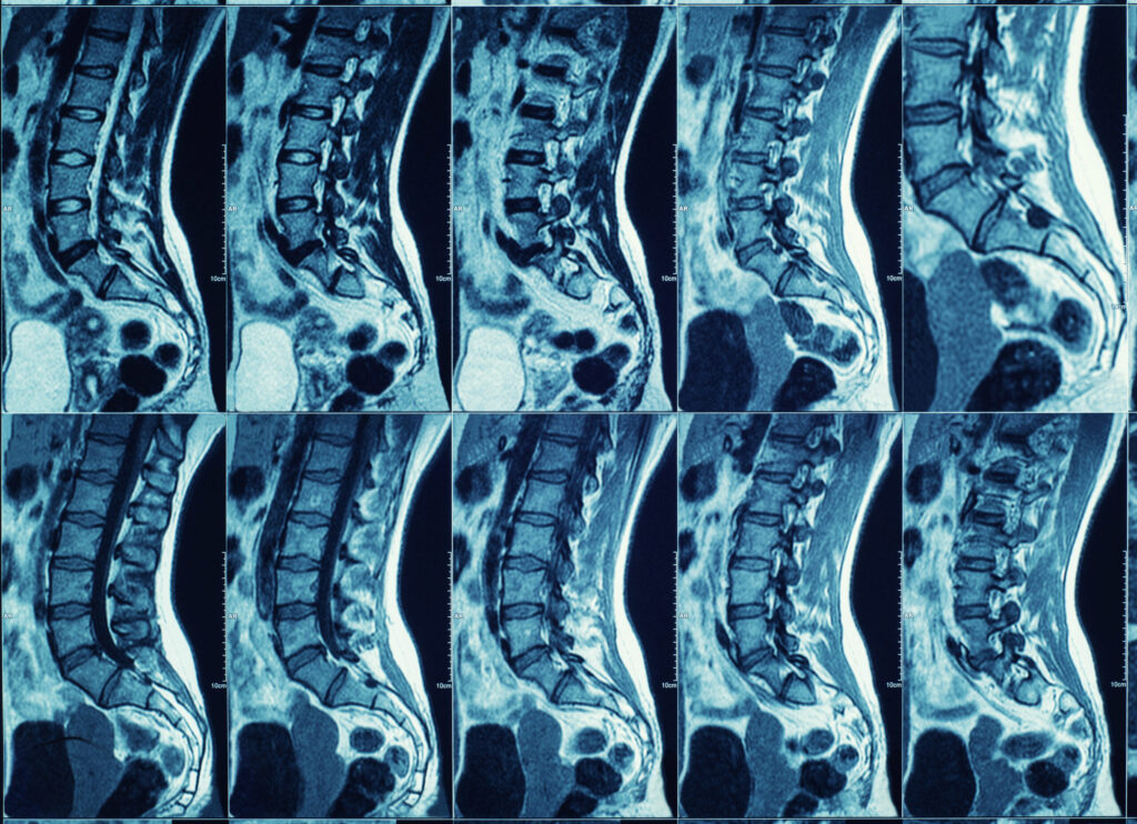 Collage of spine X-ray images accompanying an article about spinal cord stimulators.